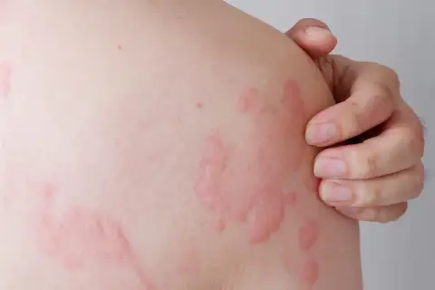 Pelle arrossata con pomfi, simile a orticaria gigante nei bambini, con mano che si gratta.